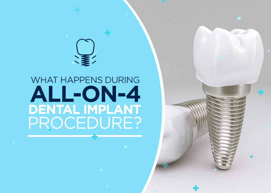 What Happens During All-On-4 Dental Implant Procedure?