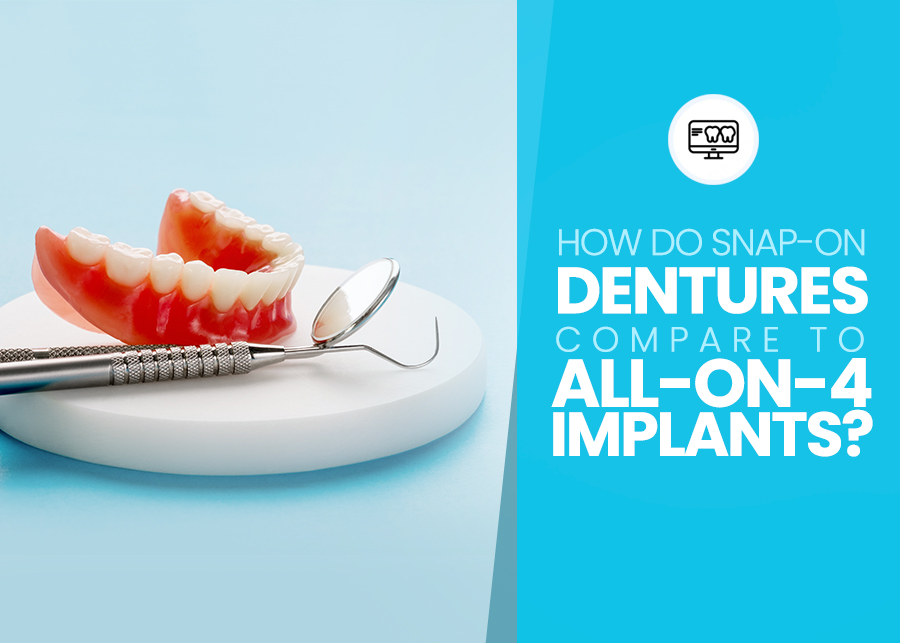 How Do Snap-on Dentures Compare To All-on-4 Implants?