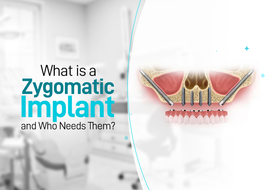 What Is A Zygomatic Implant And Who Needs Them?