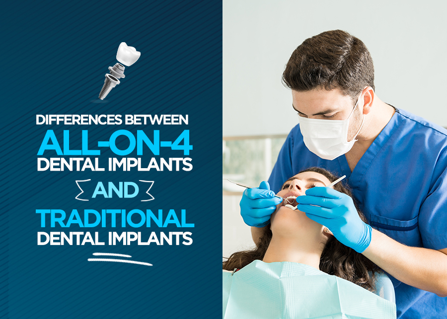 Differences Between All-On-4 Dental and Traditional Implants