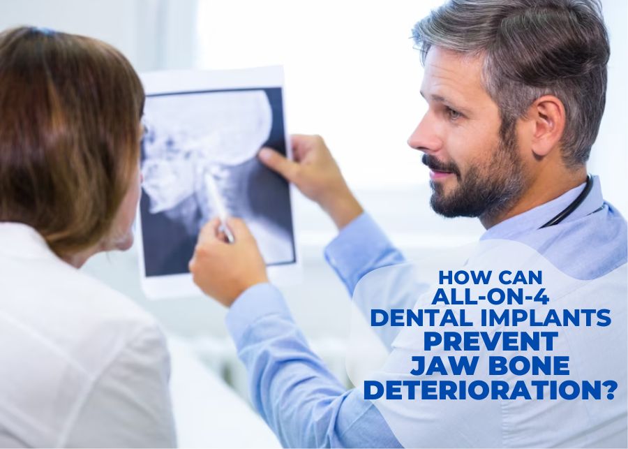 How Can All-On-4 Dental Implants Prevent Jaw Bone Deterioration?