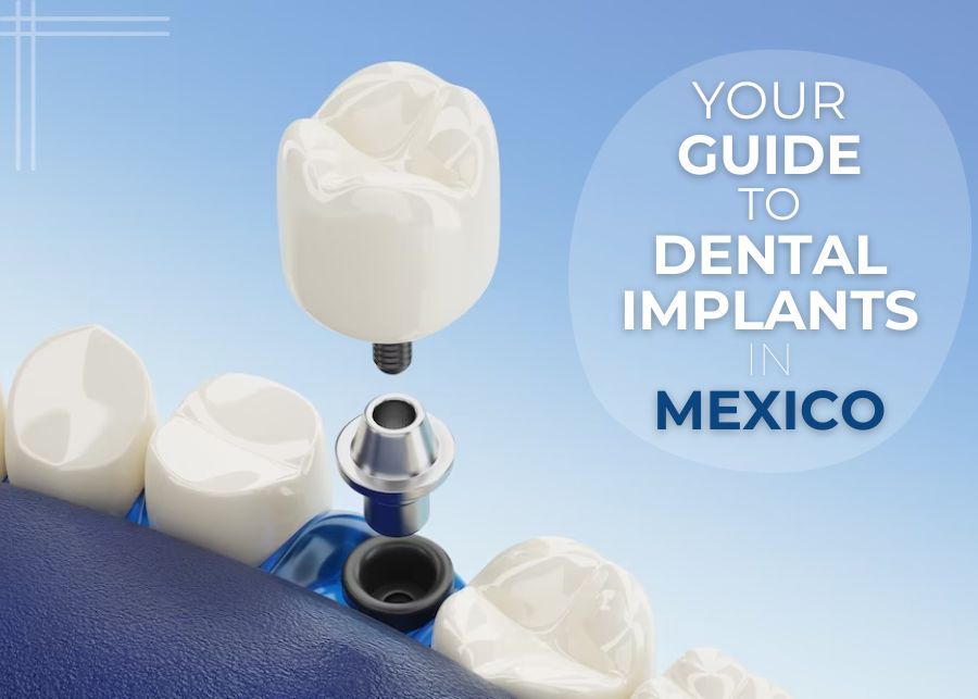 image of a dental implant with the title "Your Guide for Dental Implants in Mexico".