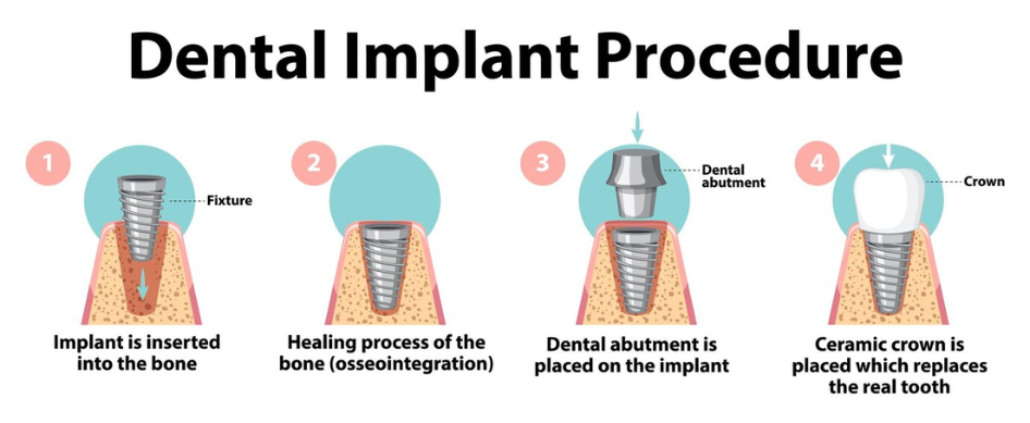 a graphic of denture implant procedure