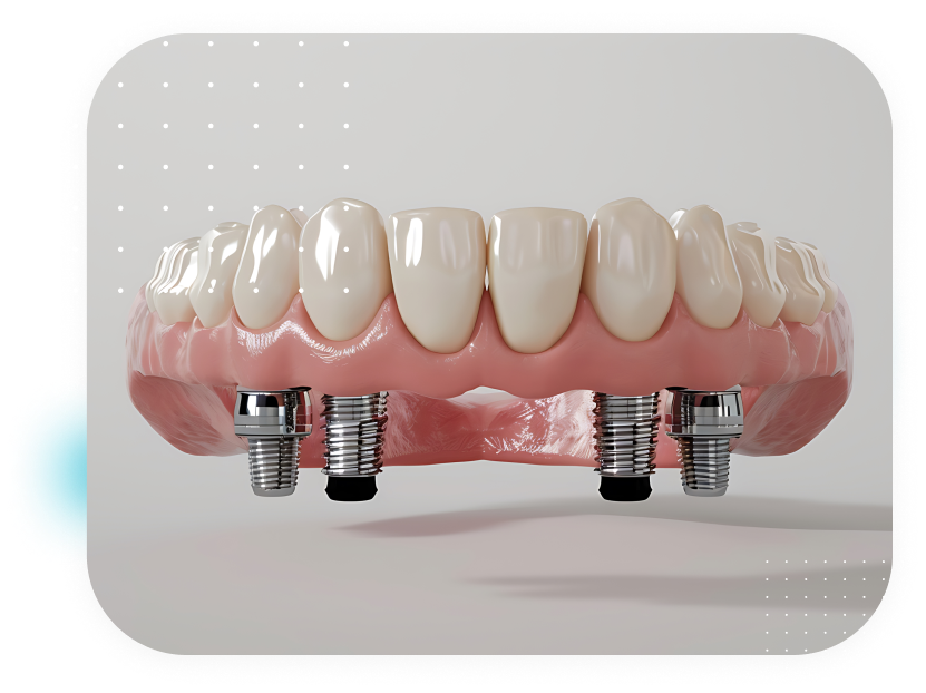 REVOLUTIONIZE YOUR SMILE WITH ZYGOMATIC IMPLANTS