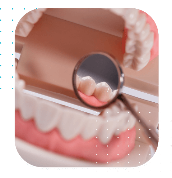 Snap On Dentures - Overdentures Mexico dental Implants