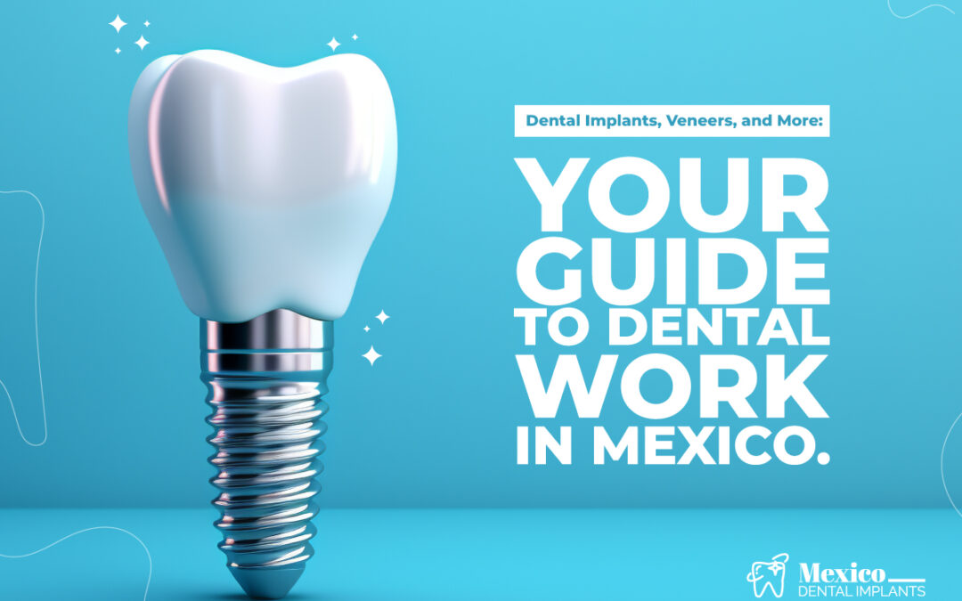 Dental Implants, Veneers, and More: Your Guide to Dental Work in Mexico