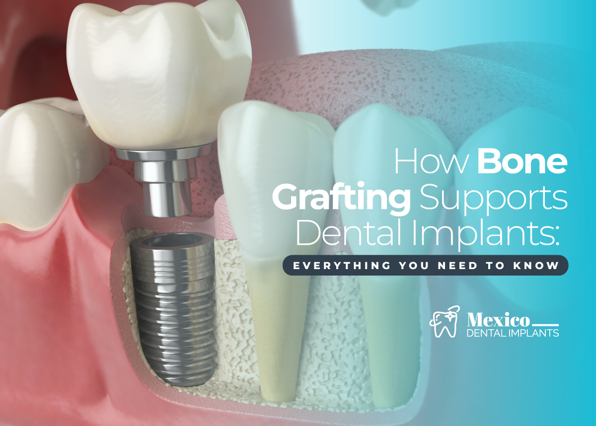 Dental Implants in Mexico vs USA