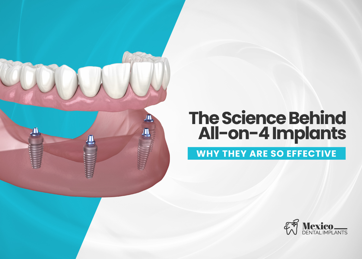 The-Science-Behind-All-on-4-Implants-Why-They-Are-So-Effective Dental Implants in Mexico vs USA