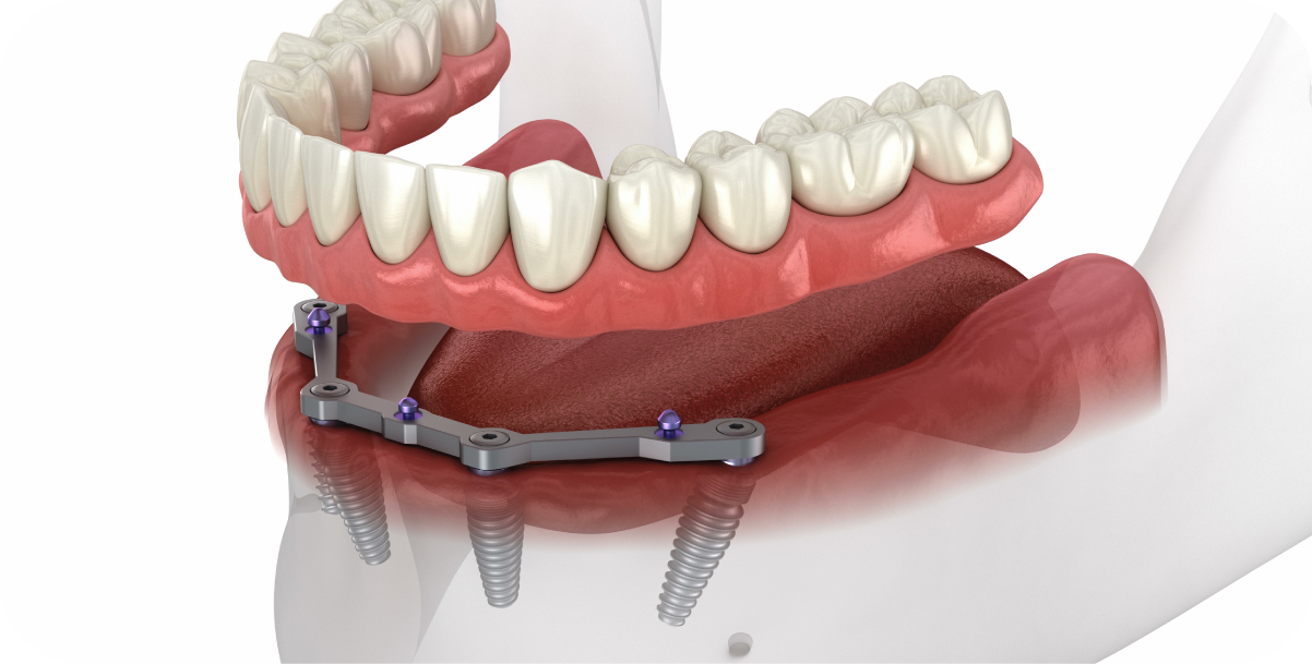 Traditional Implants