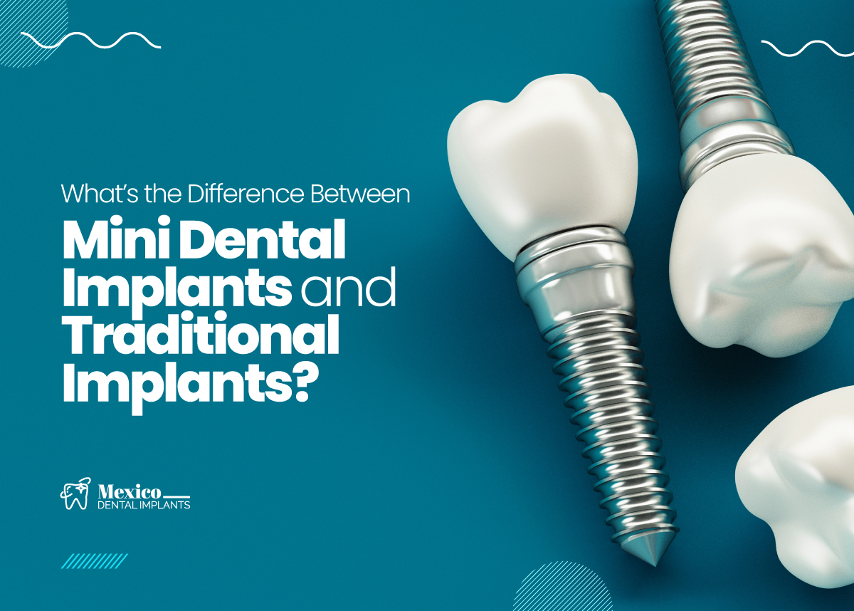 Dental Implants in Mexico vs USA