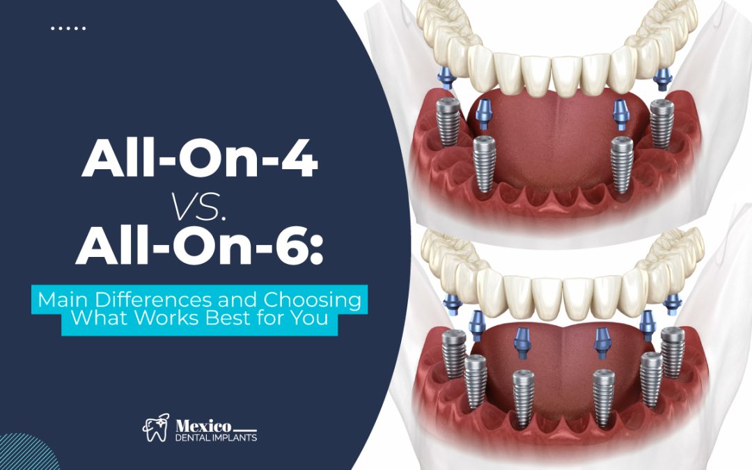 All-On-4 vs. All-On-6: Main Differences and Choosing What Works Best for You