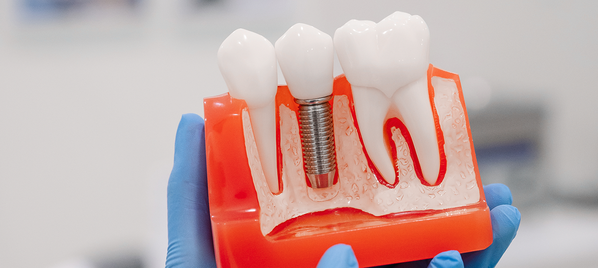 How long do dental implants last?<br />
